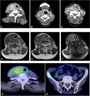 CT, MRI, and FDG-PET/CT images. (A–C) Contrast-enhanced Computed Tomography (CT) image showing a shadow with irregular margins and calcification in the right thyroid gland and swollen bilateral lymph nodes. (D‒F) Magnetic Resonance Imaging (MRI) showing a right thyroid tumor with low signal intensity on T1-weighted images (D), iso-signal intensity on T2-weighted images (E), and heterogeneous strong enhancement by gadolinium (F). (G‒H) Fluorodeoxyglucose Positron Emission Tomography/CT (FDG-PET/CT) image showing abnormal FDG accumulation in the right thyroid gland, bilateral cervical lymph nodes, and right iliac bone.