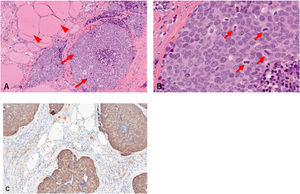 Pathological findings. (A) Normal thyroid tissue (arrowhead) with atypical epithelial cell proliferation (arrow). (B) Atypical cells with oval nuclei, uneven chromatin aggregation, and multiple fissions (arrowheads). (C) Atypical cells expressed p16.