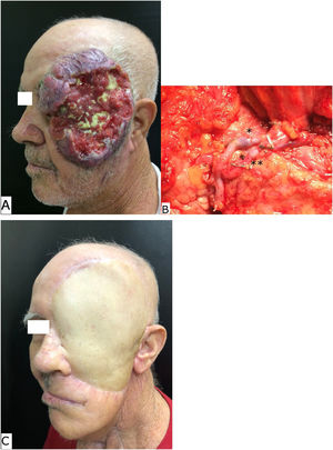(A) Pre-operative aspect of an advanced squamous cell carcinoma of the left midface. (B) The cervical recipient vessels: single asterisk demonstrates the microanastomosis of facial vein with the flap vein and double asterisk demonstrates the microanastomosis of facial artery with the flap artery. (C) The late post-operative aspect of an anterolateral thigh free flap inserted in the surgical site.