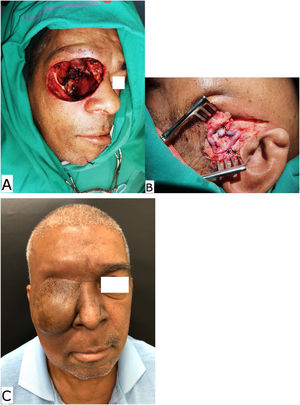 (A) Per-operative aspect of an extended right orbit exenteration due an advanced cutaneous squamous cell carcinoma. (B) The superficial temporal recipient vessels demonstrate the microanastomosis of the superficial temporal vein with the flap vein (single asterisk) and the double asterisk demonstrates the microanastomosis of the superficial temporal artery with the flap artery. (C) The late post-operative aspect of an anterolateral thigh free flap inserted in the right midface.