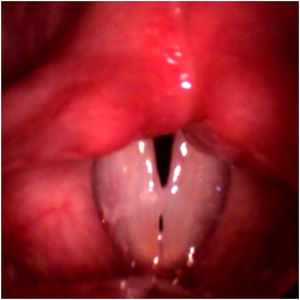 Frame of the high-speed videolaryngoscopy video referring to Case 2. Presence of bilateral lesion between the anterior and middle third is observed; the position is symmetric, with double chink (mid-posterior triangular and anterior fusiform).