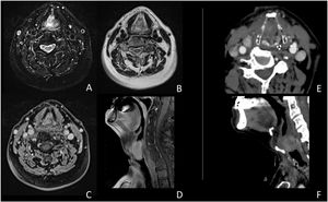 (A‒F) MRI study (A‒D); CT study (E‒F). The images document an expansive glottic lesion characterized by homogeneous enhancement after contrast injection in CT and MRI studies. In addition, obliteration of the glottic space is evident, with anterior dislocation of the thyroid cartilage shield without visible involvement of the paraglottic area and the cartilaginous structures.