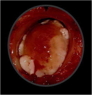 Intraoperative surgical specimen after total laryngectomy showing the transglottic mass occupying the laryngeal lumen without extralaryngeal extension.