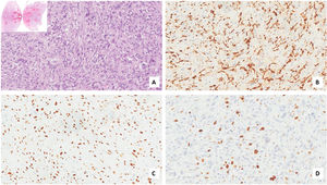 Histopathology of the larynx lesion (A–D). Neoplastic cells were negative for CKAE1/AE3 (A, 200×), CD34 (B, 200×), S100 (C, 200×), and Desmin (D, 200×).