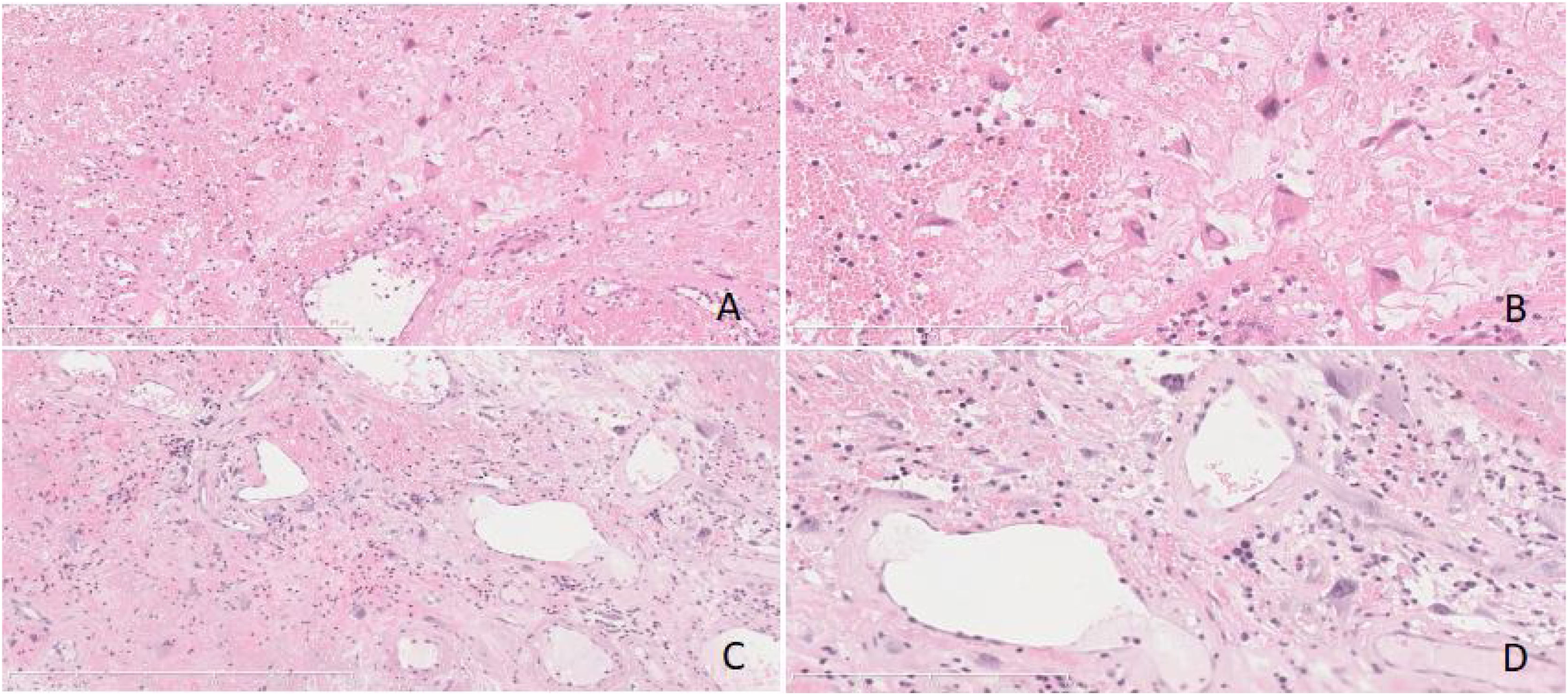 angiofibroma nasal polyp pathology outlines