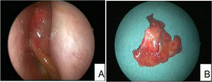 (Case 4) (A) Under nasal endoscopy, a large polypoid mass was seen in the nasal cavity. The mass was soft and smooth, with surface protrusions and vascular dilation. (B) The color of the tumor shown inhomogenous appearance (light red mixed with black and yellow).