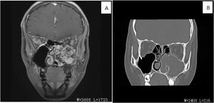 (A) Coronal fat-suppressed contrast-enhanced T1WI showed that the soft tissue mass in the left maxillary sinus displayed uneven and obvious enhancement (red arrow). Bone was discontinuous in medial wall, posterior wall and parietal wall of maxillary sinus. (B) The coronal CT bone window reconstruction image showed an expansion of the left maxillarysinus, increased density in the sinus cavity, and the lesion through the sinus opening into the left nasal cavity. The bone of the left middle and lower turbinates was resorpted, and the boundary with the lesion was unclear.