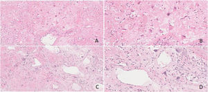 (A‒D) Some stromal cells were enlarged and pleomorphic, the nucleus was abnormal and deeply stained. Obvious dilated vascular components, accompanied by hemorrhage and infarction were also seen in the interstitum. The deposition of pink staining and amorphous protein like substance were present. (Fig. A and C, original magnification ×100, Fig. B and D, original magnification ×200, Hematoxylin and Eosin staining).