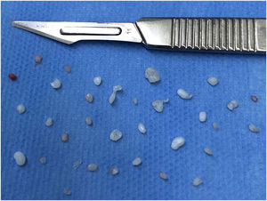 Free bodies of TMJ synovial chondromatosis removed during arthroscopic surgery.