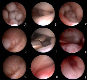 Arthroscopic images of the surgical procedure. (A) free bodies in the retrodiscal region; (B) free bodies in the middle region of the upper TMJ compartment; (C) free bodies in the posterior medial recess of the TMJ; (D) free body in the anterior recess of the anterior compartment of the TMJ, coming from the posterior region by the flow of lysis and washing; (E) pinching of free bodies in the middle region of the upper TMJ compartment; (F) free-body clamping in the posterior medial recess of the TMJ; (G) free anterior recess after removal of free bodies; (H) Middle region of the upper compartment of the free TMJ after removal of free bodies; (I) Free retrodiscal region after removal of free bodies.