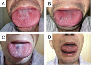 Physical examination of the tongue. Preoperative examination showed that the patient’s tongue was swollen, wider than the periodontal area, and the gum was pressed outward. The tongue is hard, and its activity is limited (A). Reswelling of the tongue was observed a week after surgery (B). 3 months after surgery (2 months after chemotherapy), the tongue was reduced (C). 3 months after surgery (2 months after chemotherapy), the tongue body can be lifted (D).