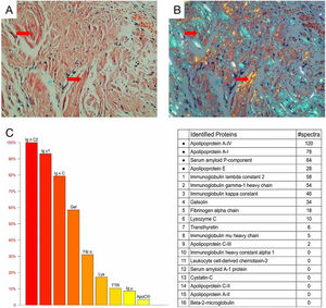 Histological and proteomic characteristics of AL amyloidosis. Tongue biopsy stained with Congo red revealed extensive amyloid deposition (A; Red arrow), the characteristic abnormal colors of orange and green were observed under a polarized light microscope (B; Red arrow). Proteomic analysis showed that high abundance of amyloid chaperone protein ApoAIV, SAP, ApoE was identified. The relative abundance of Igλ was the highest among the known proteins, suggesting that it was ALλ (C).