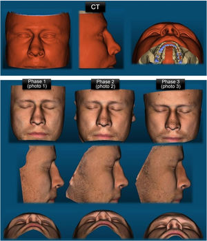 Representation of the 3D meshes produced in a male patient, reconstructed from the CT of the facial sinuses and by photogrammetry in the different capture phases.