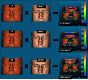 Representation of heat maps resulting from Cloud-to-Mesh (C2M) comparisons of pairings with the absolute mean distance in a male patient.
