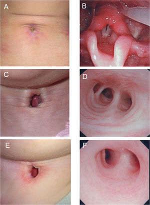 Findings of tracheostoma and trachea. (A) Successful decannulation was achieved 42 days after surgery in TwTT case. (B) Endoscopic findings showing no laryngeal stenosis in TwTT case. (C) Stable permanent tracheostoma without granulation tissue in TwPT case. (D) Endoscopic findings showing no tracheal stenosis in TwPT case. (E) Stable permanent tracheostoma without granulation tissue in APS case. (F) Endoscopic findings showing no tracheal stenosis in APS case.