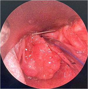 Solid tumor at the left supraglottic region at the laryngoscopy, when the patient was first admitted at the hospital.