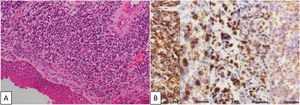 Histopathology (A) tumor with a diffuse pattern of infiltration (H&E, enhanced 200×); (B) immunohistochemistry panel: the tumor showed positive myogenin, desmin, vimentin and CD56, and high index of cell proliferation (KI67+80%) (Enhanced 400×).