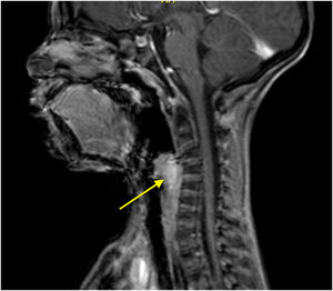 Cervical MRI, in sagittal plane. Arrow point to a well-defined nodular supraglottic expansive lesion, centered at the left aryepiglottic fold, presenting enhancement after contrast, without restriction to diffusion, measuring 2.5×1.8×2.4cm.