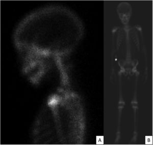 (A) detail in neck region; (B) Whole body bone scintigraphy showing normal distribution of the radiopharmaceutical, according to age and bone framework.