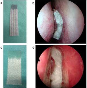 (a) AQUACEL® Ag Advantage cut into quarters. The upper part was gelatinized with water. (b) AQUACEL® Ag Advantage was inserted as nasal packing after endoscopic sinus surgery. (c) KALTOSTAT® cut into quarters. The upper part was gelatinized with water. (d) KALTOSTAT® was inserted as nasal packing after endoscopic sinus surgery.