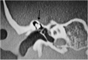Arrow indicates malformed ossicular chain with fixation of the malleus head and incus body.