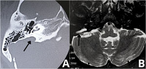 Enlargement of vestibular aqueduct (black arrows). (A) Right ear. Axial scan. Temporal bone high-resolution computed tomography. (B) MRI ‒ T2-weighted sequence of the same patient.