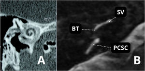 (A) Advanced otosclerosis with double ring/halo sign. (B) MRI ‒ T2-weighted sequence of the same patient showing stenosis of the scala tympani in the basal turn. BT, Basal Turn; SV, Scala Vestibuli; PCSC, Posterior Semicircular Canal.