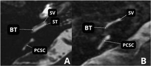 (A) MRI ‒ T2-weighted sequence A. Normal. (B) Advanced otosclerosis with showing stenosis of the scala tympani in the basal turn. BT, Basal Turn; SV, Scala Vestibuli; ST, Scala Tympani; PCSC, Posterior Semicircular Canal.