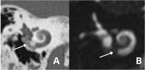 (A) Obliteration of the round window and part of basal turn.A ‒ Temporal bone high-resolution computed tomography; (B) MRI ‒ T2-weighted sequence.