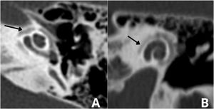(A) Arrow indicates otospongiosis in the area of the oval window. (B) Double ring/halo sign around the cochlea showing otospongiotic stage with probable sensorineural hearing loss.