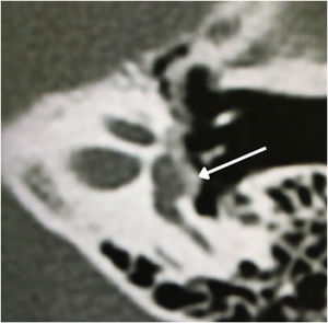Footplate involvement by hypodense foci bone.