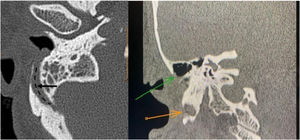 Axial section: the arrow (black) shows the location of the communicating vein, and the dashed line shows its length. Coronal section: orange arrow shows signs of mastoidectomy, and green arrow shows where the lumen of the vessel is.