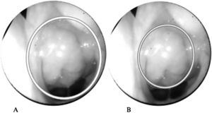 Nasal endoscopy to evaluate the rhinopharynx using the Pro Image J Software. (A) Area of the choana estimated by Software Pro Image J. (B) Area of adenoid tissue estimated by Software Pro Image J.