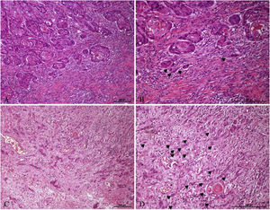 Examples of LSCC cases with low- and high-grade tumor budding. (A) An example with low-grade tumor budding (<7 buddings), where an invasive front arranged in large nests of cells with occasional presence of tumor budding is observed (Hematoxylin and eosin staining, ×100). (B) Low-grade budding (black arrow) under 200× magnification (Hematoxylin and Eosin staining). (C) Example with high-grade tumor budding (≥7 buddings), where the invasive front of the tumor is observed on the left where in the area of invasion there are abundant individual cells infiltrating the stroma (Hematoxylin and Eosin staining, ×100). (D) High-grade budding (black arrow) under 200× magnification (Hematoxylin and Eosin staining).