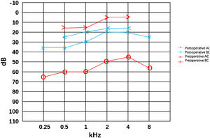 Conductive hearing loss preoperative with a gap of 45 dB and the gap decreased to 8 dB postoperative.