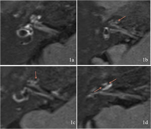 Degree of cochlear endolymphatic hydrops. (1a) Right cochlear Endolymphatic Hydrops (EH) is grade 0. (1b) Right cochlear EH is grade 1. (1c) Right cochlear EH is grade 2. (1d) Right cochlear EH is grade 3. Orange arrow shows the area of EH.