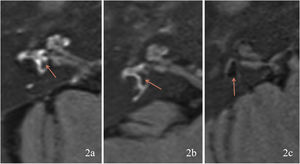 Degree of vestibular endolymphatic hydrops. (2a) Right vestibular Endolymphatic Hydrops (EH) is grade 0. (2b) Right vestibular EH is grade 1. (2c) Right vestibular EH is grade 2. Orange arrow shows the area of EH.