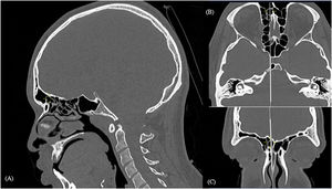 Supra agger frontal cell. Computed tomography: mark shows right supra agger frontal cell in sagittal (A), axial (B) and coronal (C) reconstructions.