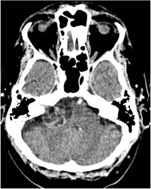 A large vestibular schwannoma in the right CPA.