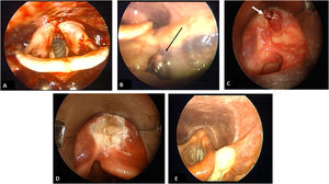 (A) Indirect laryngoscopy showing a large amount of fresh blood in the hypopharynx. (B) Indirect laryngoscopy revealing varicose vessels, black arrow, in the left vallecula. (C) Direct laryngoscopy with umbilicated varix, white arrow, with clot adhered to the apex. (D) Direct laryngoscopy shows the vallecula’s left region after cauterization of the lesion. (E) Indirect laryngoscopy on the 8th post-operative day evidencing granulation tissue.