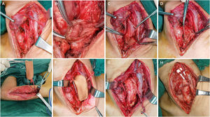 Detailed surgical processes for esophageal reconstruction in Case 11.
