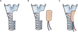 Schematic LAFF for tracheal defect reconstruction in Case 6.
