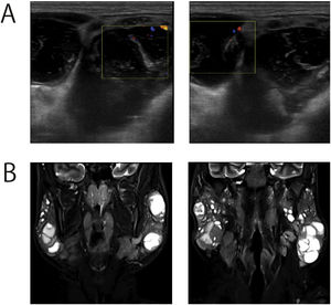 Imaging examination of a patient with benign lymphoepithelial cysts. (A) Ultrasound images. Multiple cystic lesions were detected in both parotid glands. (B) Numerous cystic lesions and no obvious tumors were observed on ultrasound imaging.