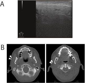 Imaging examination of a patient with pneumoparotid. (A) Ultrasound images. There were no obvious abnormal findings. (B) Gas infiltration was detected in the right parotid gland (white arrows).