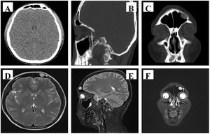 CT of the sinuses showed a frontal sinus mass (A, Position of cross section; B, Sagittal section; C, Coronal section). MRI of the sinuses showed a frontal sinus mass (D, Position of cross section; E, Sagittal section; F, Coronal section).