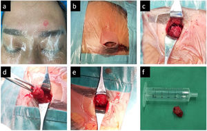 Preoperative localization of the raised mass on the upper edge of the left eyebrow arch (a). The incision was designed at the eyebrow arch (b). The mass was exposed while the surrounding area of the mass was sanded with a skull rotation (c). The bone mass in the frontal sinus was removed (d). After the bone mass of frontal sinus was completely removed, the mucosa of frontal sinus was well preserved without damage (e). The whole frontal sinus bone mass was taken out for measurement and comparison (f).