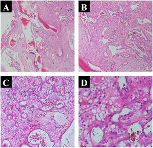 Ossifying hemangioma of the frontal sinus showed mature trabecular bone and multiple small vascular Spaces under different microscope magnification (H&E, A, Enhanced 40×; B, Enhanced 100×; C, Enhanced 200×; D, Enhanced 400×).