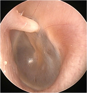 A white, horn-shaped, firm mass in front of the short process of the malleus in the left anterior bony external auditory canal.