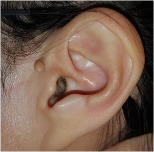 A soft accessory lobe in front of the left tragus.