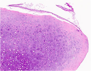 Histopathologic image revealing a mass composed of mature hyaline cartilage covered with squamous epithelium (Hematoxylin-Eosin, ×100).